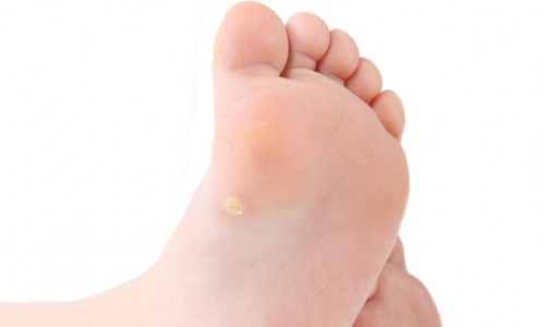 wart on sons foot
